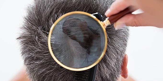 Πιτυρίδα: Η αλήθεια και οι μύθοι για κάτι που όλους λίγο πολύ μας απασχολεί